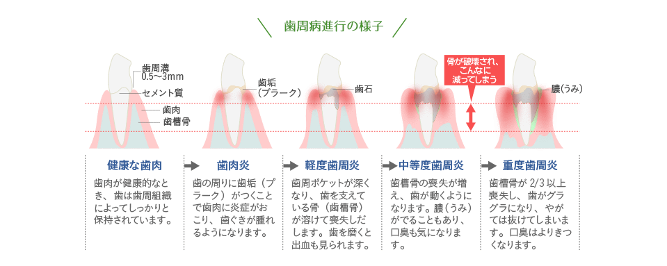 歯周病進行の様子イラスト