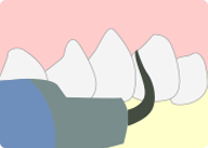 歯石の除去イラスト